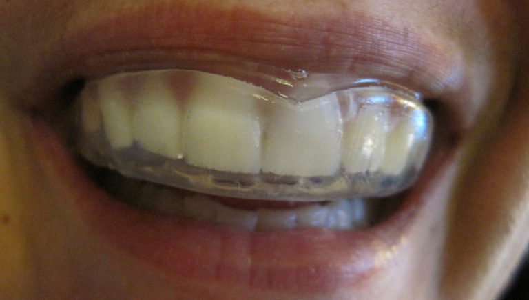 mouthguard on teeth