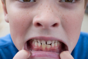 boy with chipped bottom tooth